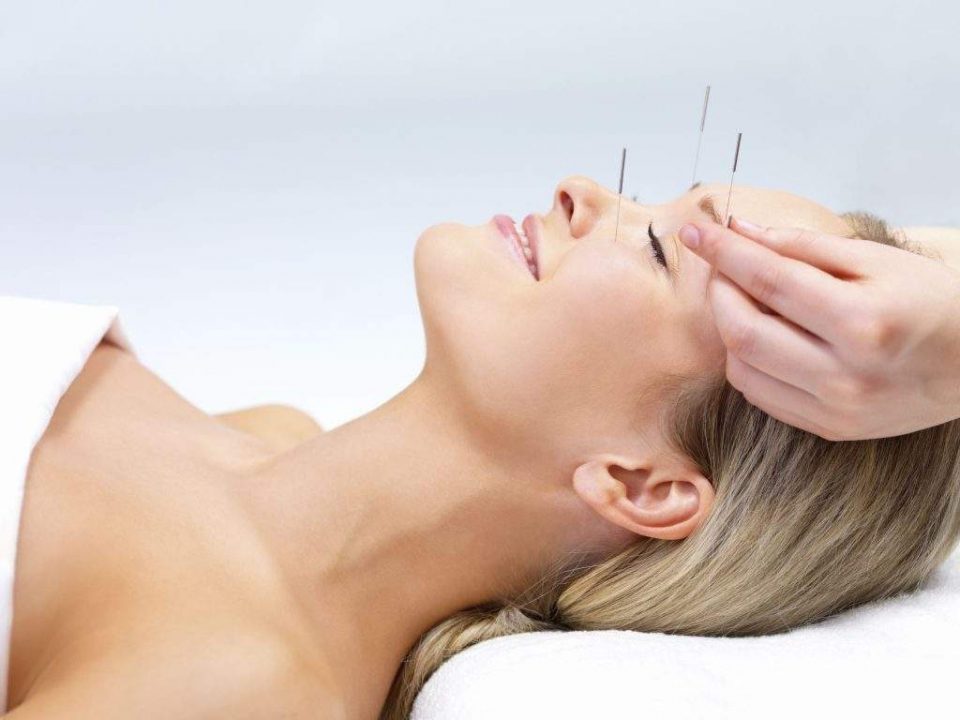 acupuntura para enxaqueca e cefaléia