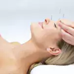 acupuntura estetica