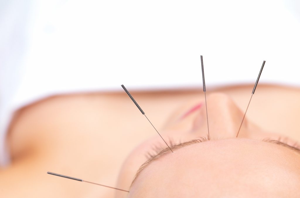 Tratamento de ansiedade com acupuntura