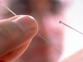 Como são as agulhas na acupuntura