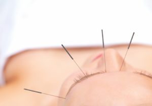 Como é Realizada a acupuntura para ansiedade?