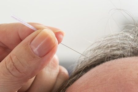 Efeito analgésico da acupuntura