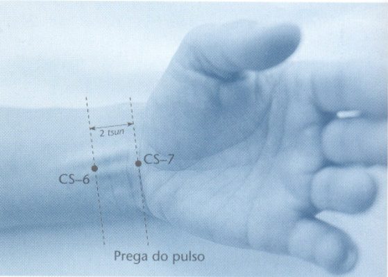 CS6 acupuntura neiguan localização