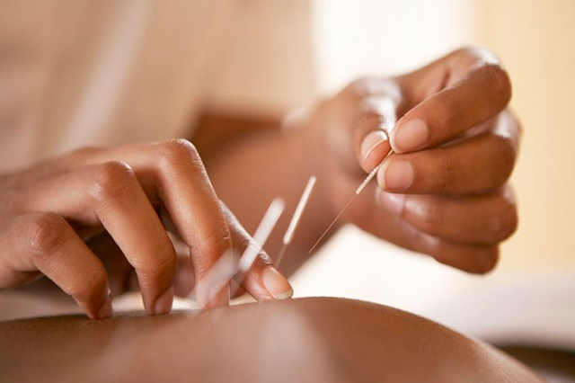 Como e realizada a acupuntura
